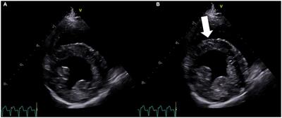 Case report: Naturally occurring neurogenic stunned myocardium in a dog secondary to status epilepticus